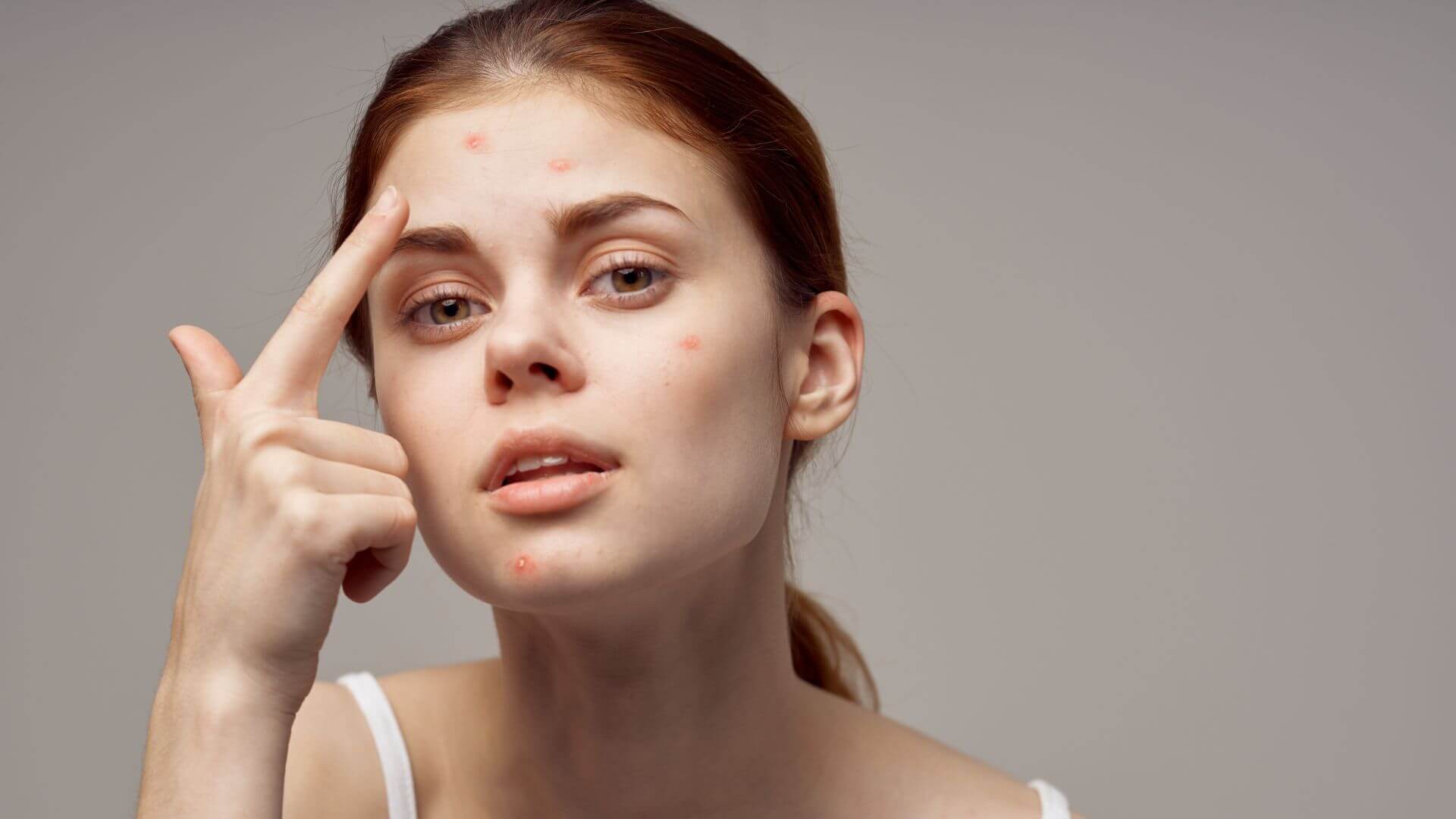 Acne on The Back How To Treat It (1)