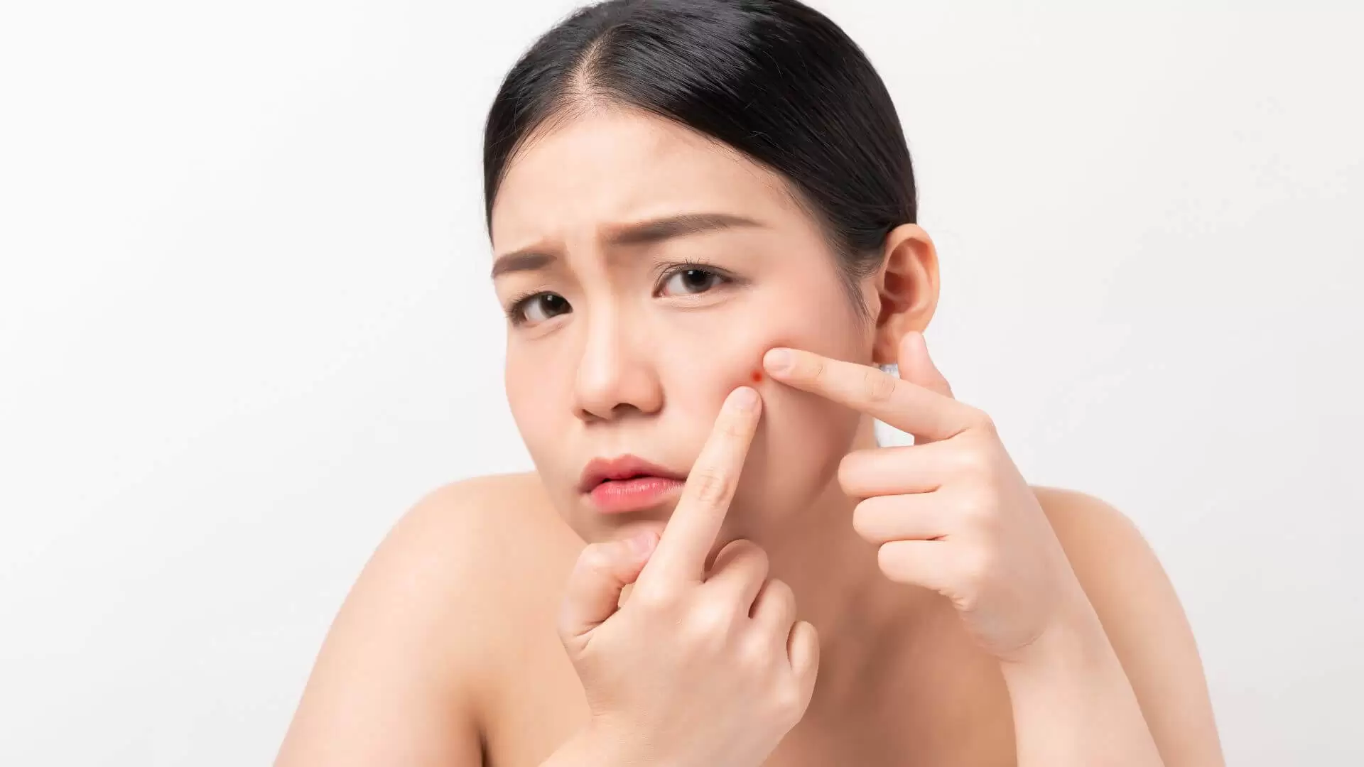 Pimples And How Fat Cells Help Fight Acne (1)