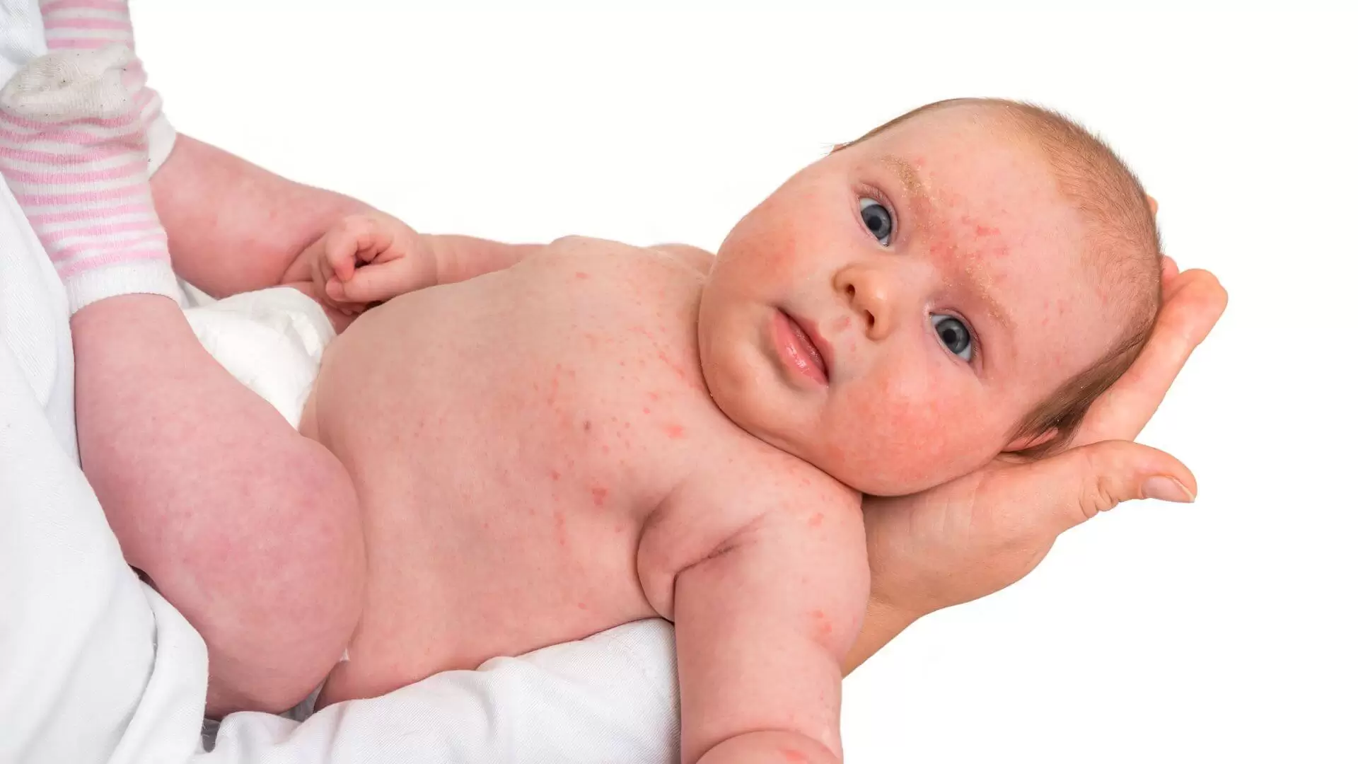 Does Your Baby Have Pimples And You Don’t Know How To Take Care of His Skin (1)