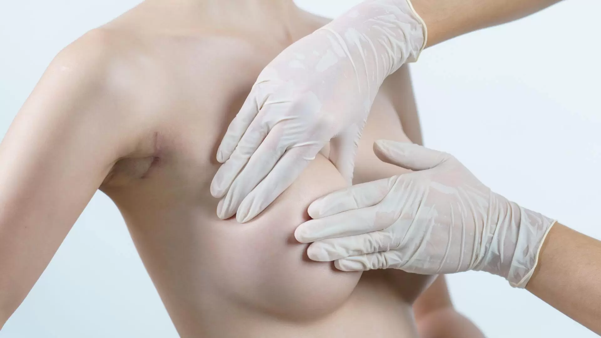 What You Should Know About Breast Implant Removal (1)
